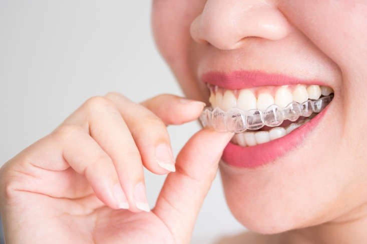 the process of Invisalign treatment