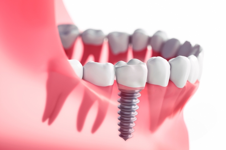 the benefits of dental implants