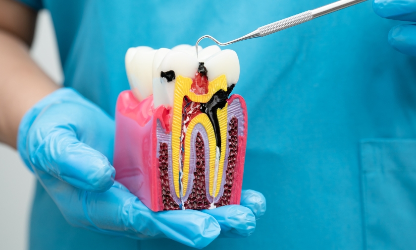 Why Is Root Canal Therapy The Best Solution For Tooth Pain?