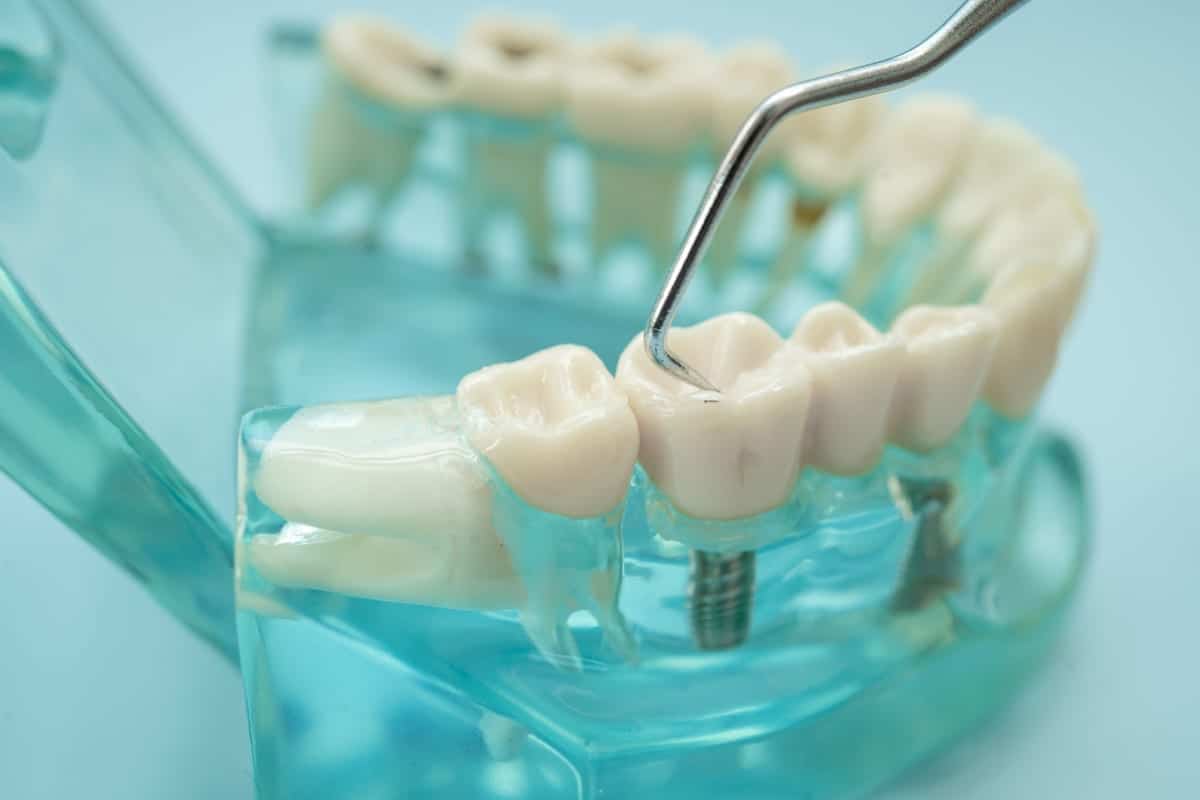 Dental Bridges in Stallings